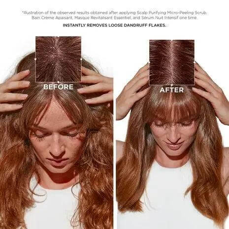 Before and after results using Symbiose Bain Crème Apaisant shampoo on hair with dandruff and a sensitive scalp.