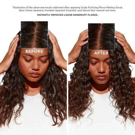 Comparison of before and after using Symbiose Bain Crème Apaisant, showing dandruff removal on a woman's scalp.